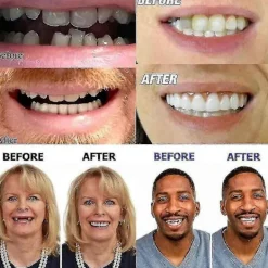 Konstgjorda Tänder Proteser Temporära Snabba Tandproteser Topp Perfekt Leende Fanér, Reparera Din Tand Snabbt, Få Dig Att Le Självsäkert><noscript><img width=