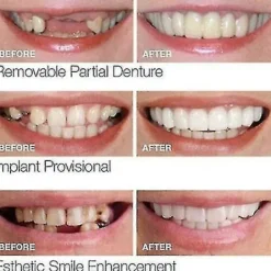 Smile Snap On Lösa Tänder Övre Nedre Tandfasader Proteser Tandskydd Set PTW><noscript><img width=